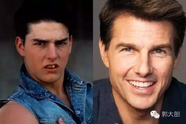 缺一颗门牙能戴隐形牙套吗,门牙龅牙医生建议磨小戴牙套