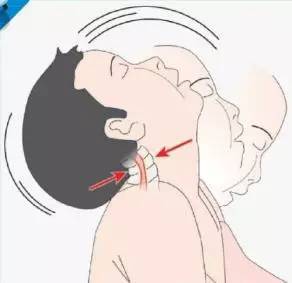 宝宝斜颈该怎么办？这些知识妈妈必须知道！