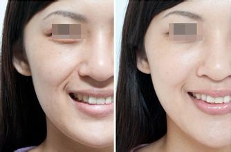 瑞蓝二号玻尿酸除皱,玻尿酸眼部除皱剂量