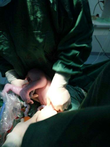 顺产和剖腹产要挨一刀吗,剖腹产可以横一刀竖一刀吗