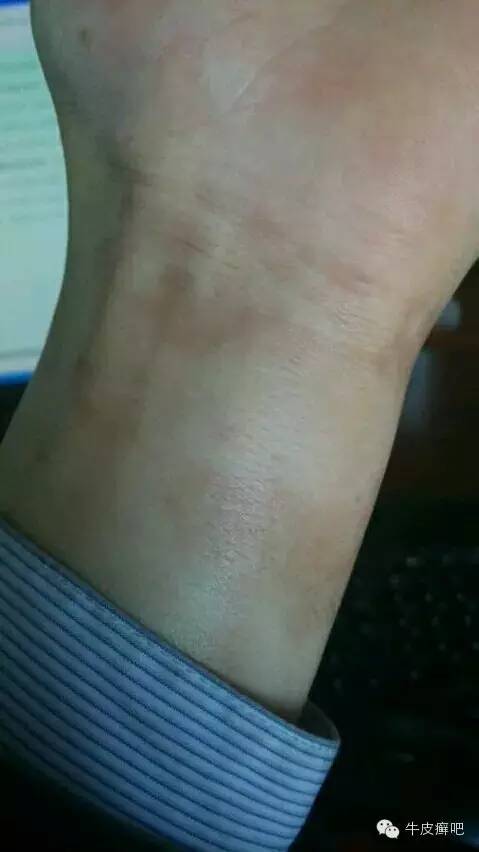 医院专家教你治疗牛皮癣,专家专治牛皮癣方法