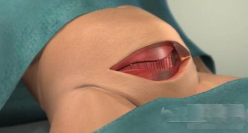 剖腹产女人不可逆的伤害,剖腹产请善待妈妈