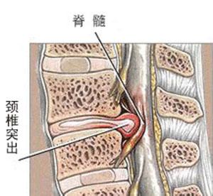 颈椎3-7节狭窄和突出的症状,颈椎管狭窄压迫神经根的症状