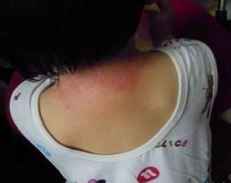 孩子身上起红疙瘩很痒什么情况,身上起红疙瘩还痒图片