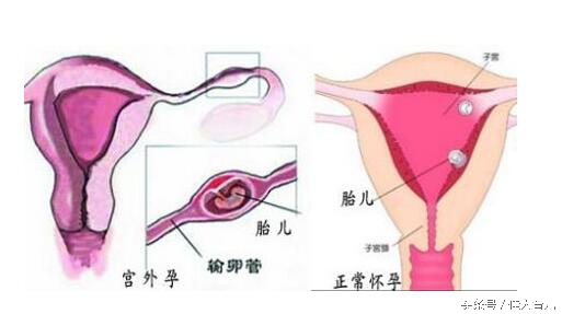 女子吃避孕药发生宫外孕,紧急避孕造成宫外孕
