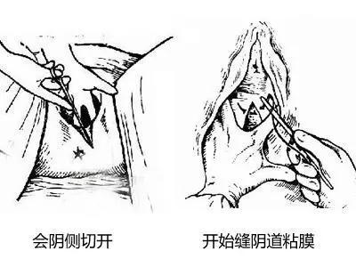 会阴侧切？新妈妈你知道多少？