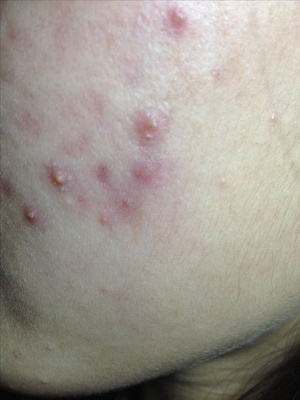 皮肤出现红血丝怎样修复,皮肤薄有红血丝有什么办法缓解