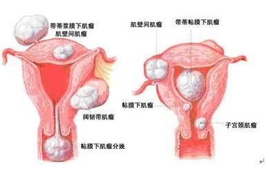 正常女性可以切除子宫吗,正常女性可以去切除子宫吗