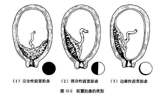 孕妈千万别盲目保胎,孕妈胎盘低要怎么办