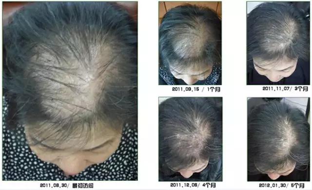 白发补染发根与染全头哪个危害大,染白发发根染黑了怎么处理