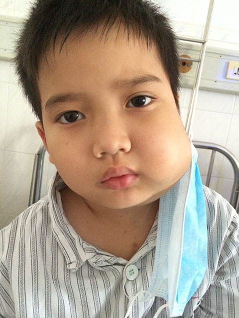 智齿发炎烦恼,智齿含牙囊肿需要尽早拔除吗