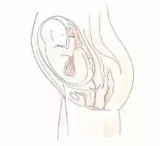 孕期躺着笑都漏尿,孕期笑多了会怎么样