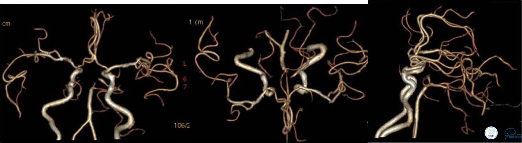 冠状动脉慢性闭塞的介入治疗,颅外段锥动脉狭窄的介入治疗