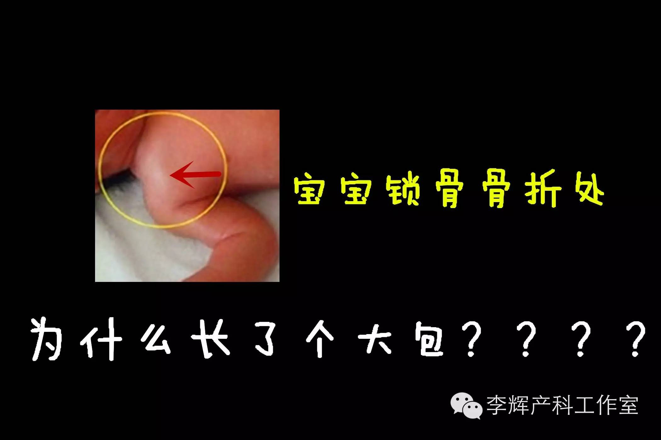 新生儿为什么会锁骨骨折,顺产宝宝锁骨骨折的原因