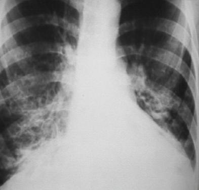 支气管扩张最有诊断价值的检查是,什么是支气管扩张和哮喘