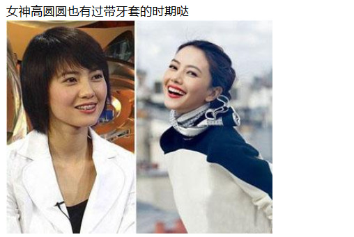 高圆圆戴牙套前后对比,高圆圆牙齿矫正牙套戴了几年