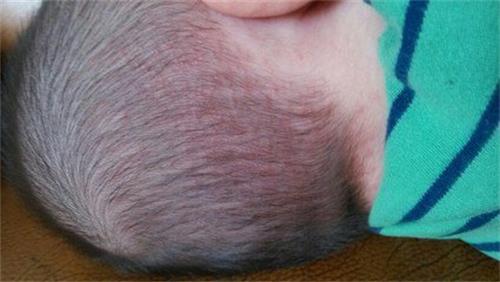 新生儿耳朵长痱子,新生儿宝宝脸上长了小颗粒像痱子