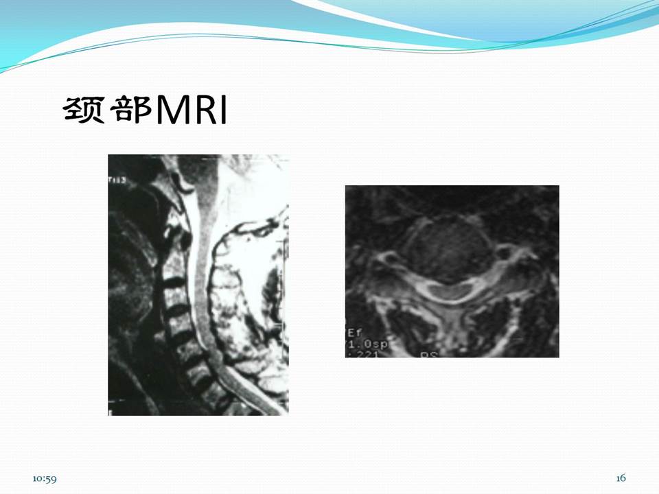 谈骨论筋颈椎病,中医治疗颈椎病名医