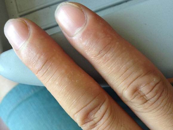 手上奇痒无比的小水泡,手上起小水泡痒用什么药