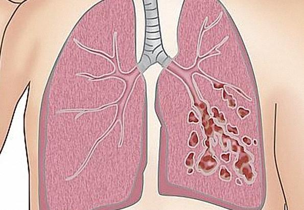 支气管扩张最有诊断价值的检查是,什么是支气管扩张和哮喘