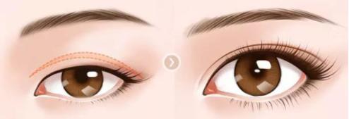 师丽丽开讲第四期：上睑下垂怎么治疗?