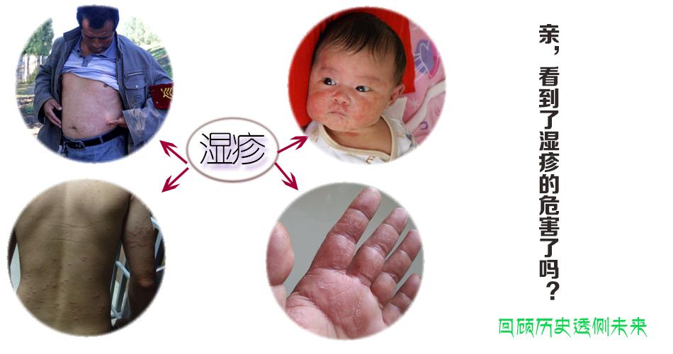 中医药治疗儿童湿疹,中医治疗湿疹最有效的药