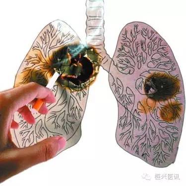 柳叶刀肺癌,柳叶刀肿瘤治疗方法