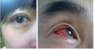 眼睛里有血丝吃什么药能消除,眼睛有血丝而且还模糊怎么消除