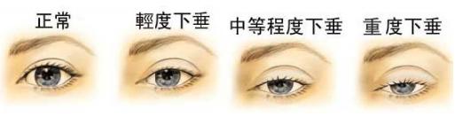 师丽丽开讲第四期：上睑下垂怎么治疗?
