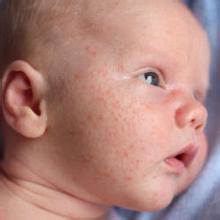 湿疹反复发作代表没找出病因吗,婴儿湿疹的诱发原因