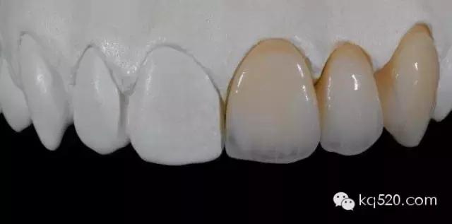 烤瓷牙变黑有必要更换吗,烤瓷牙边缘变黑怎么办