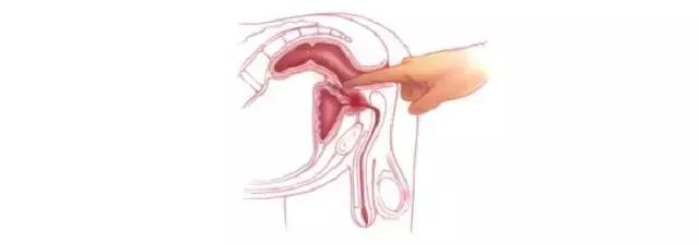 这这项检查只要20元,很多人却不愿意做!结果患上直肠癌!