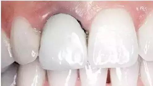 烤瓷牙变黑有必要更换吗,烤瓷牙边缘变黑怎么办