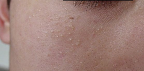 眼睛周围皮下的脂肪粒怎样去除啊,眼睛周围的扁平疣怎么消除脂肪粒