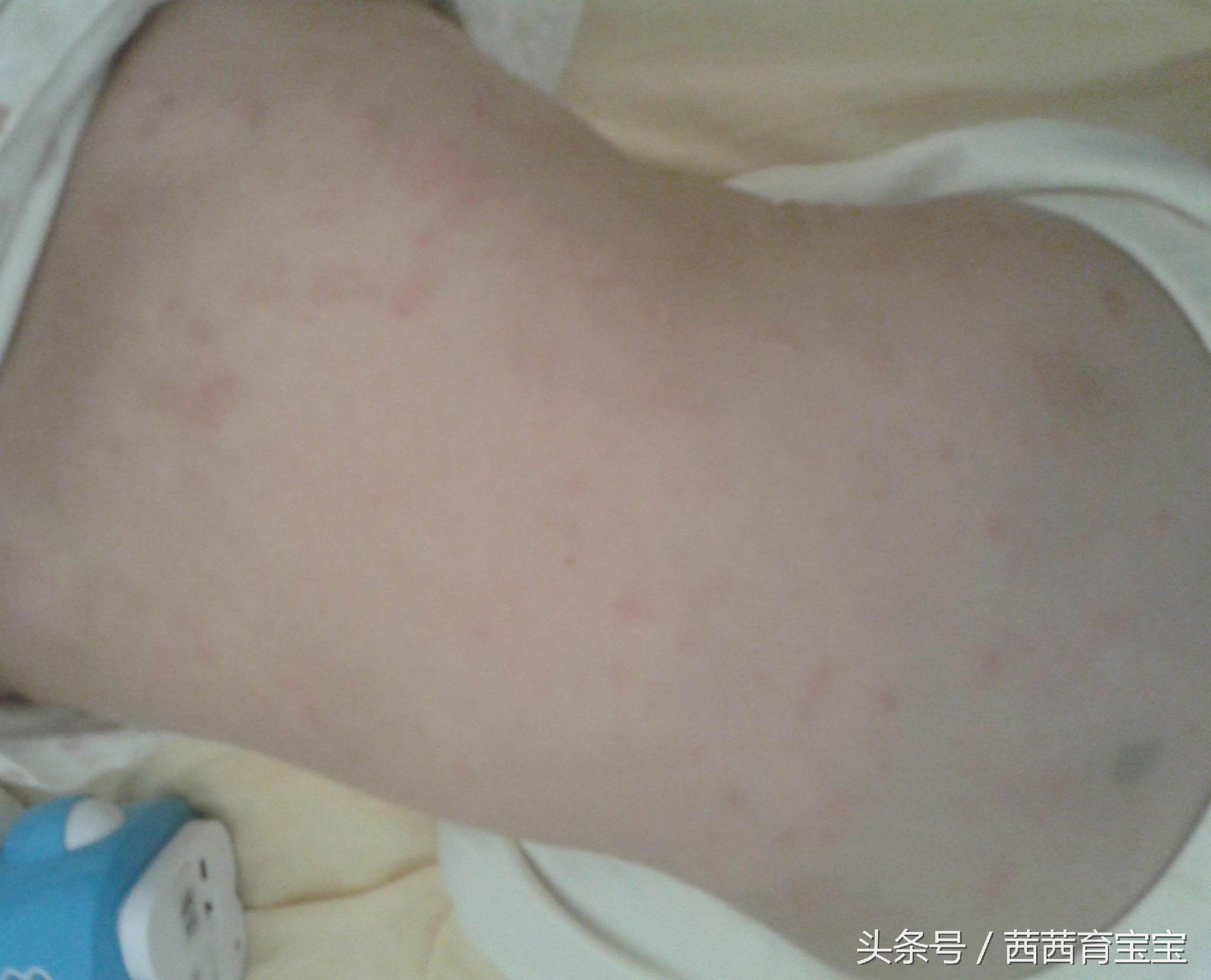 宝宝长湿疹涂什么药膏,宝宝喝奶长湿疹怎么办