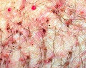 中药治咳嗽50例,80岁老中医治咳嗽草药