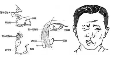 口眼歪斜护理要素！这四点你应该掌握