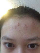 去掉额头上的痘痘用什么药膏,如何让额头上的痘痘消失