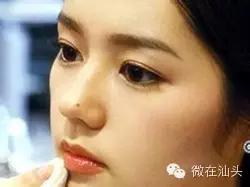 点痣会引发痣癌变吗,痣旁边长了小痣是不是癌变