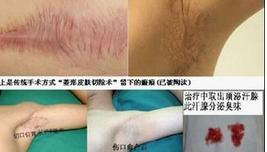 疤痕不可以做腋臭手术吗,腋臭手术半年后疤痕发痒是怎么了