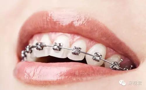 牙齿矫正舌侧牙套经历分享,牙齿矫正隐形牙套真人日记