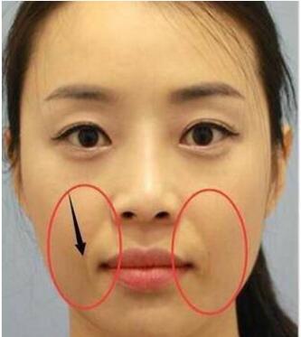 法令纹贴对去法令纹有效果吗,舌头顶法令纹能去除法令纹吗