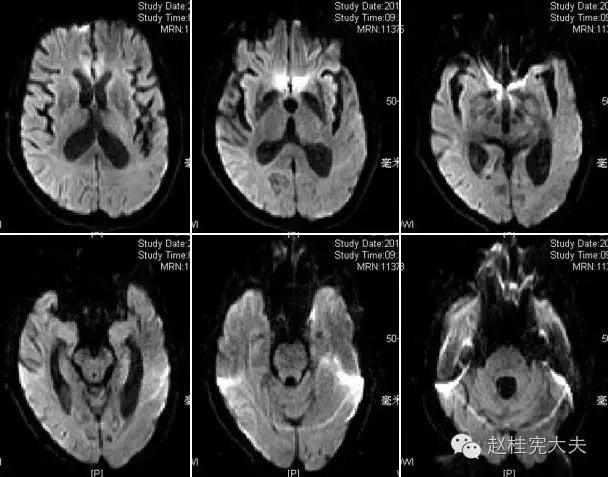 脑卒中简单科普,年轻人是不是不要担心脑卒中