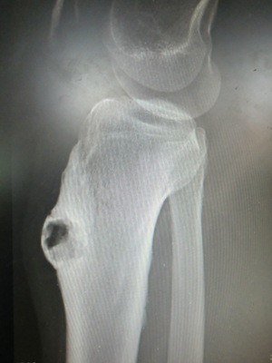 足球运动膝关节损伤康复,足球运动员有胫骨骨膜炎