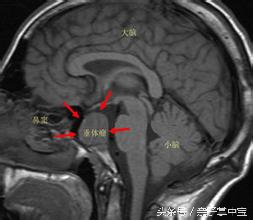 女子不孕不育多吃什么好,女子不孕吃偏方引发肝癌