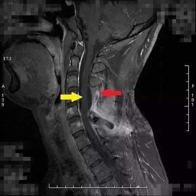 台湾林口长庚质子治疗怎么样,重庆长庚医院质子治疗成功案例