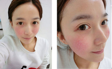 脸上有红血丝应该怎样护理,脸上有血丝怎么修复