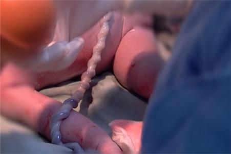 胎儿脐带扭成麻花会导致胎停吗,胎儿调皮把脐带玩成麻花状