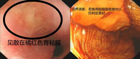精细胃镜检查（二）——色素内镜（上）