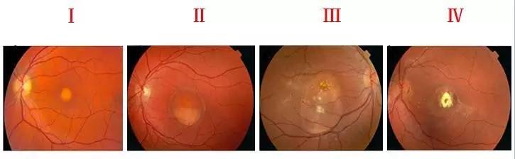 CCOS2016眼底陈有信教授:Best病及基因型与表现型研究